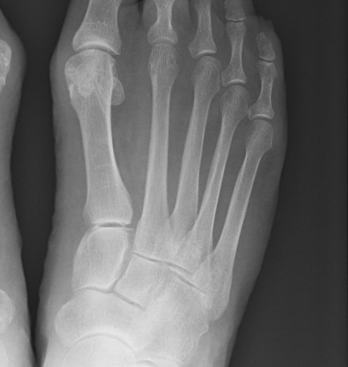 Foot Medial Column Normal